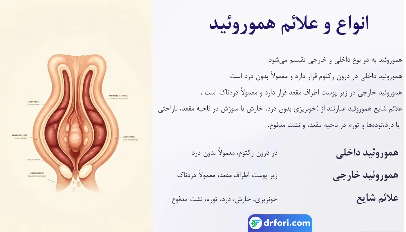 انواع بواسیر