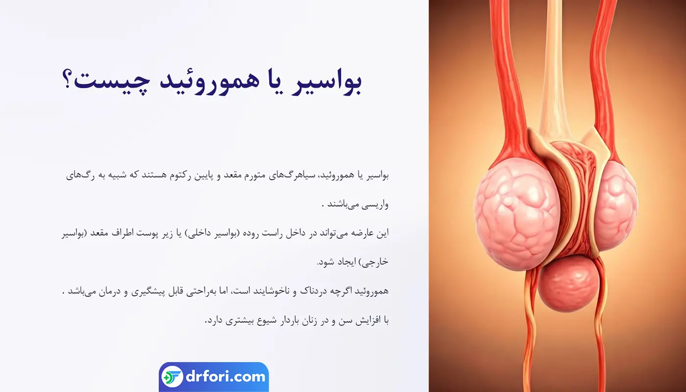 بواسیر چیست؟