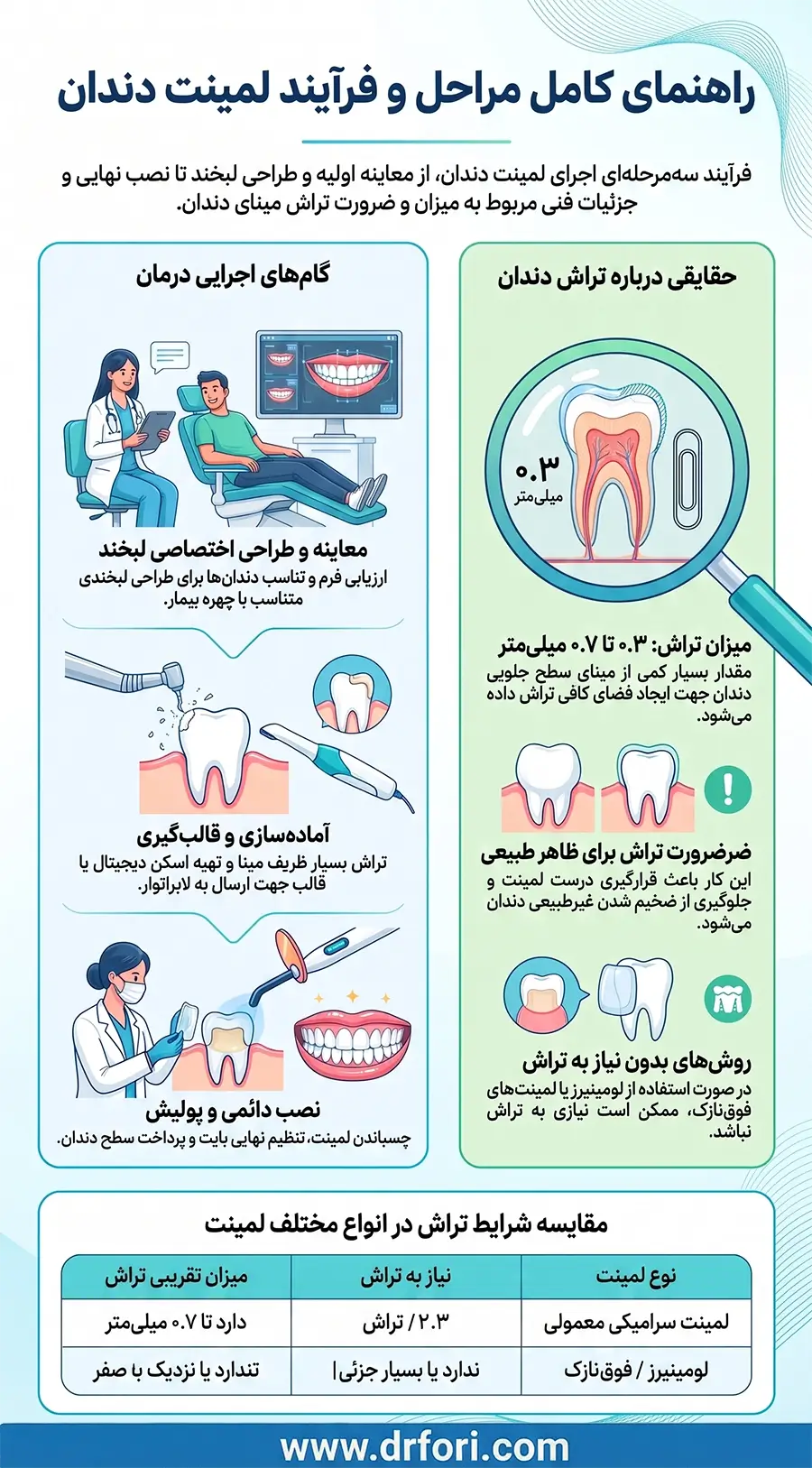 فرایند لمینت دندان
