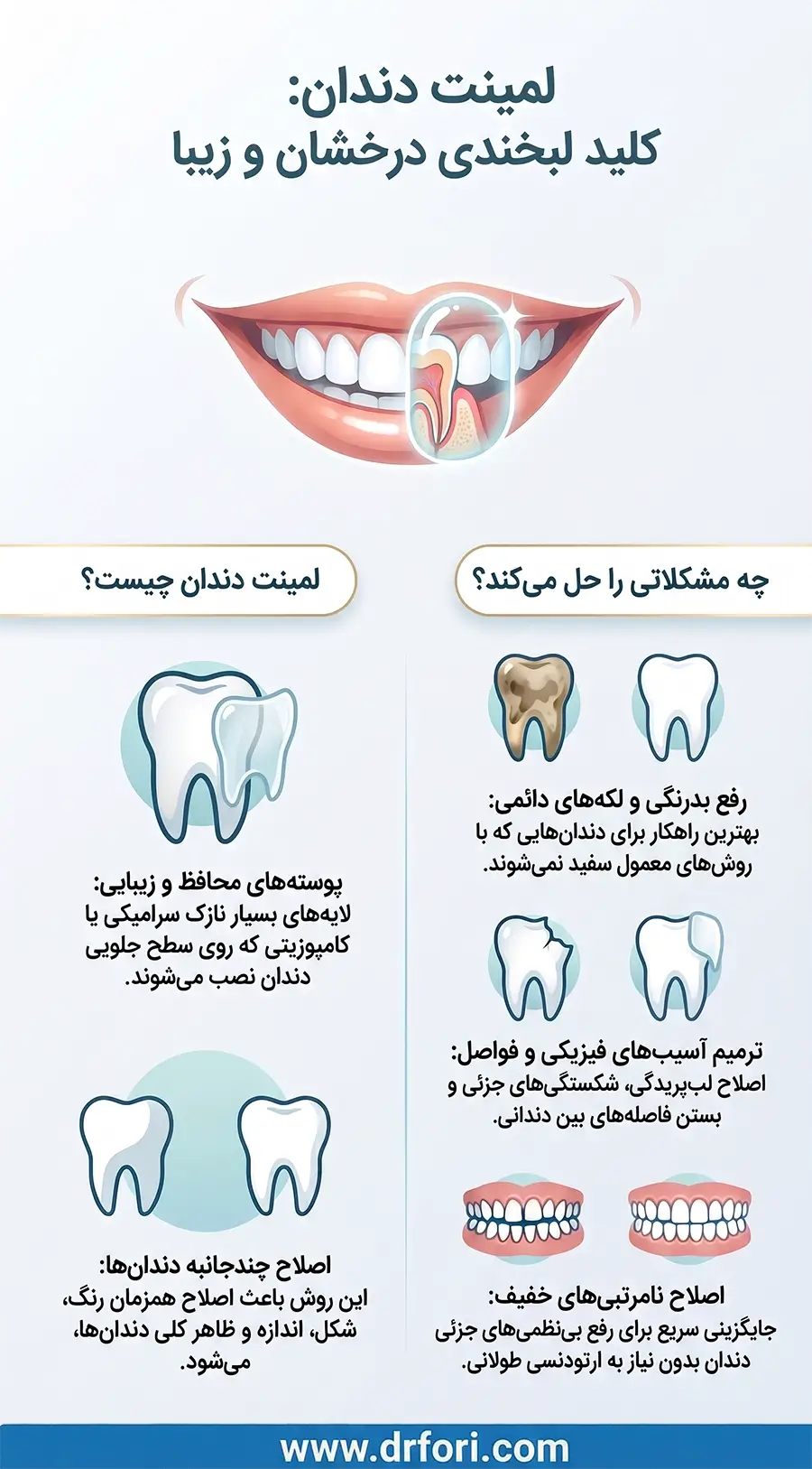 لمینت دندان چیست