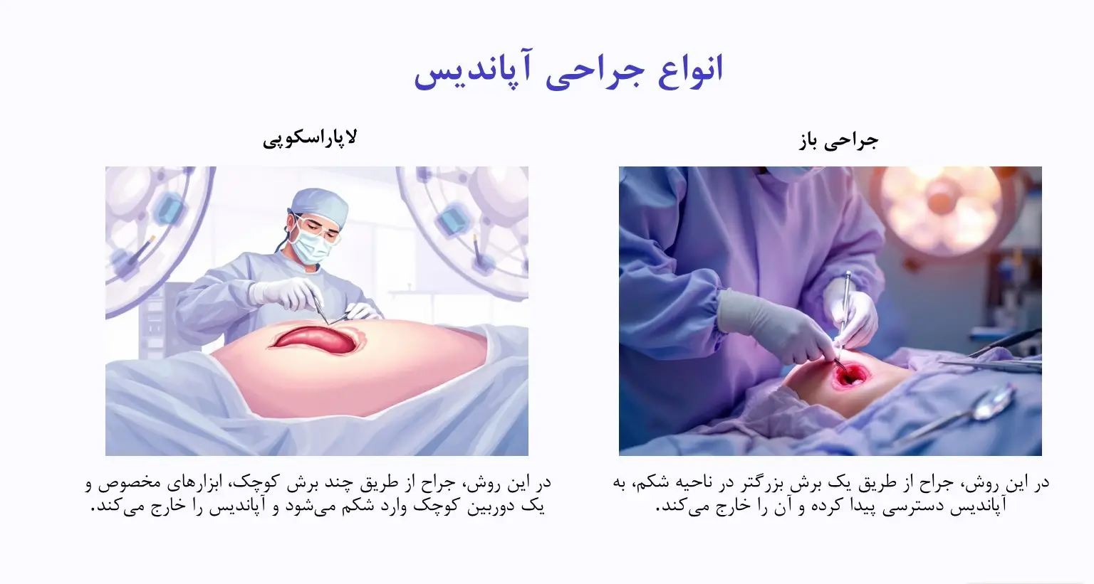 انواع جراحی آپاندیسیت