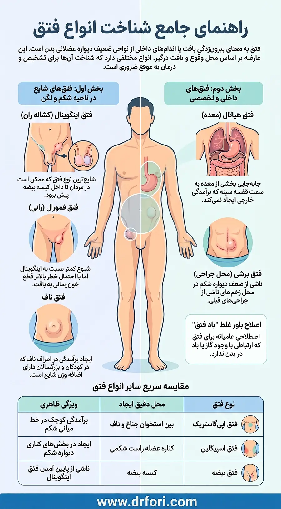 انواع فتق