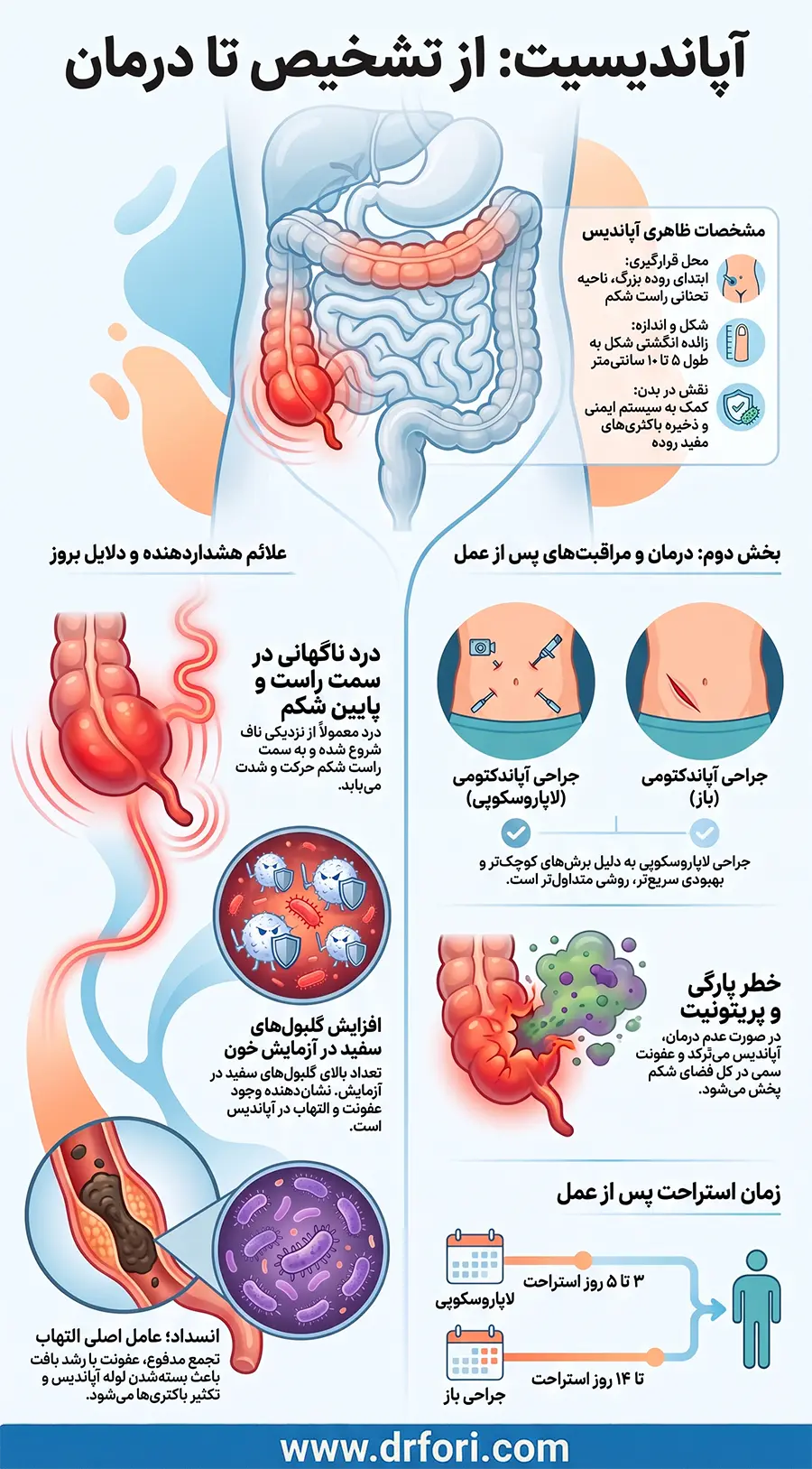 اینفوگرافیک آپاندیسیت