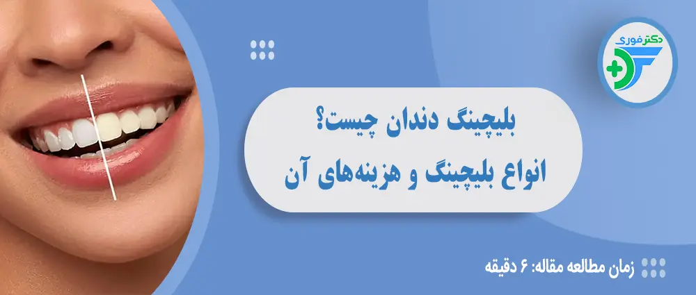 بلیچینگ دندان چیست؟ انواع بلیچینگ و هزینههای سفید کردن دندان