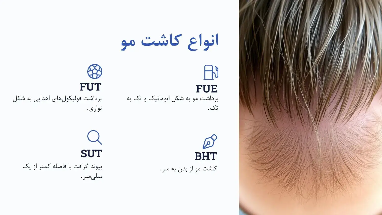 انواع کاشت مو